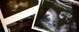 Ultrasound images of an unborn child / Coeur d'Alene Press, Jerome A. Pollos for AP